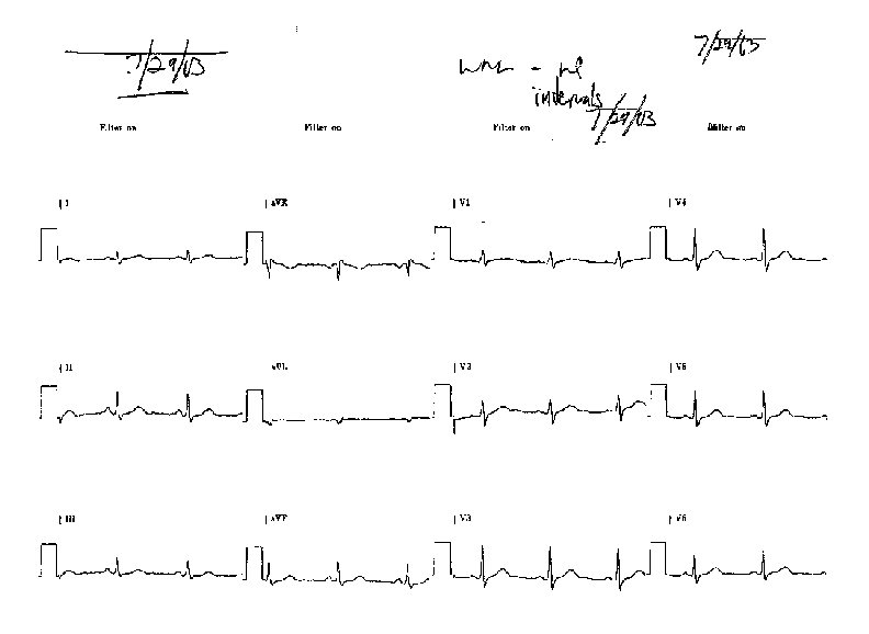 EKG