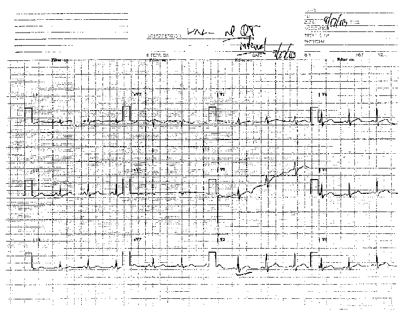 EKG