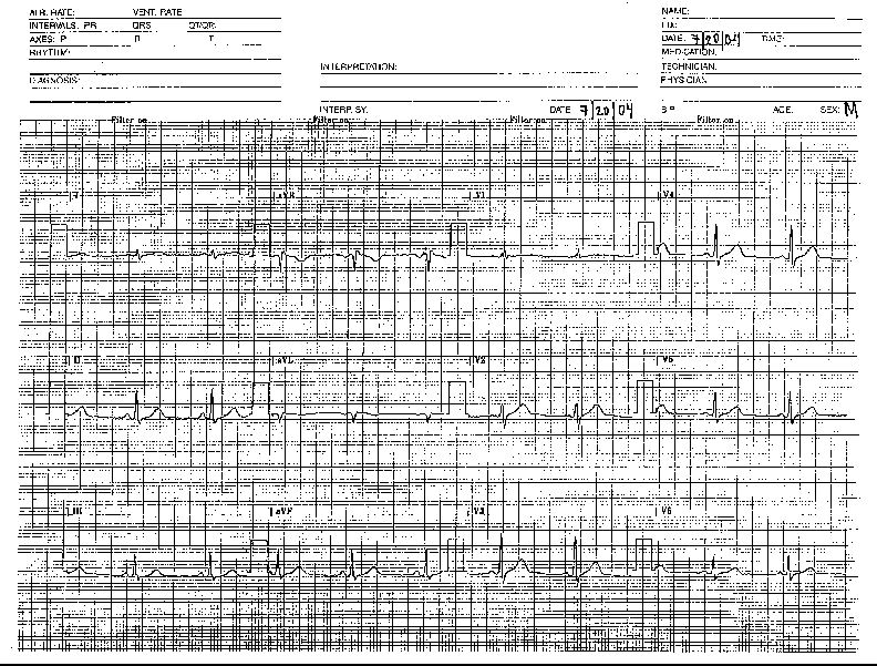 EKG