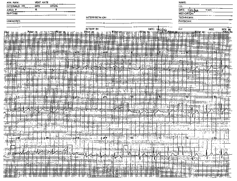 EKG