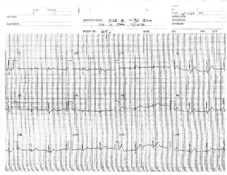 EKG